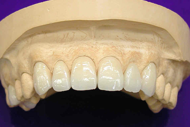 歯の機能性も考慮した治療