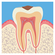 虫歯レベル1（C1）