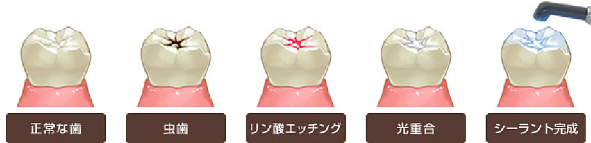 シーラント