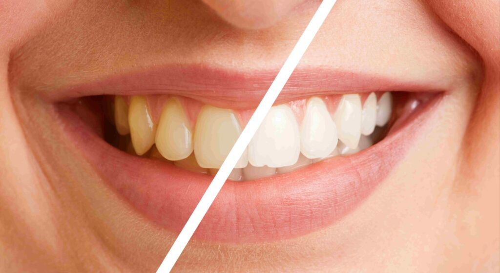 歯の黄ばみを白くする方法